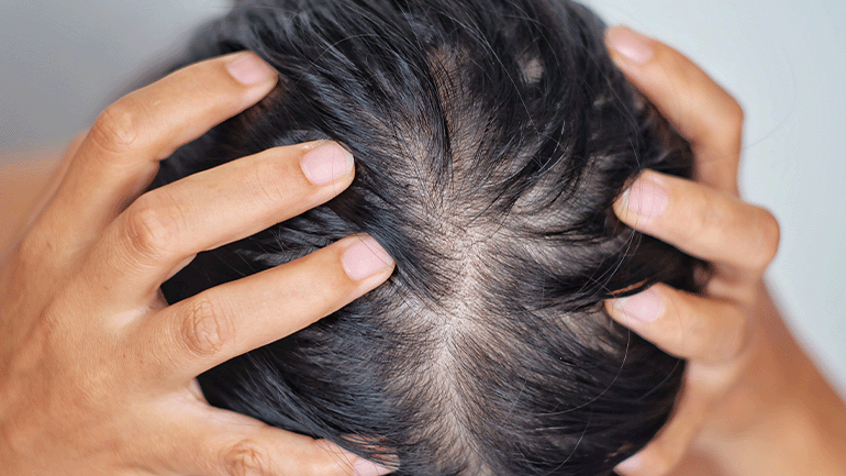 Can a Hair Transplant Help with Thinning Hair